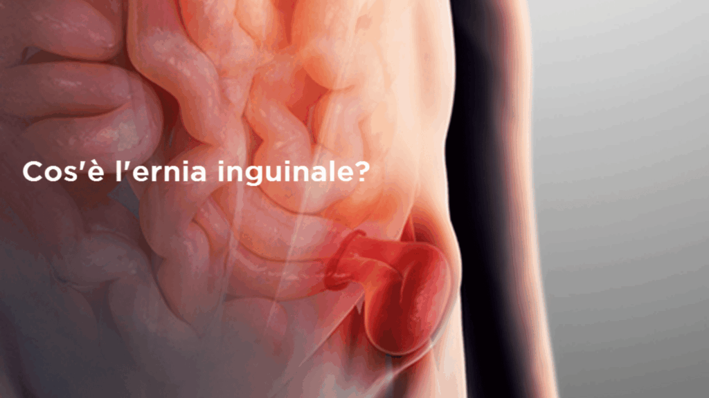 Ernia Inguinale
