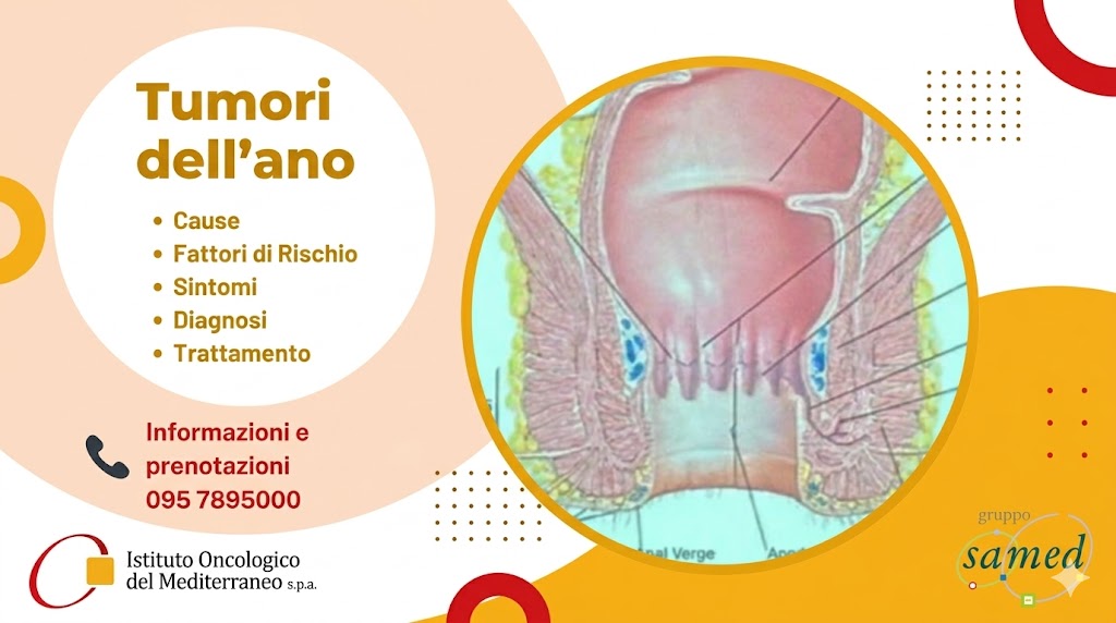 Il tumore dell'ano